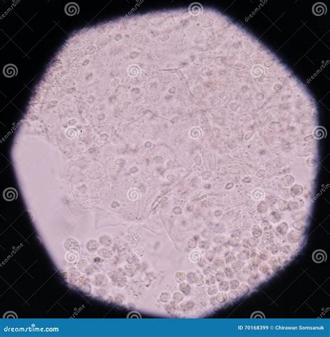 Moderate White Blood Cells Red Blood Cells Bacteria Cells In Uri Stock