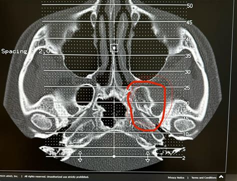 Does This Ct Scan Look Normal R Sinusitis