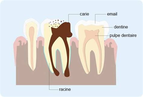 Définition causes et symptômes de labcès dentaire