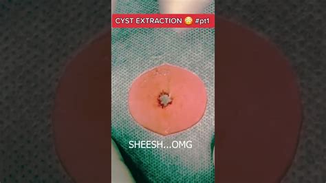 Sheesh Omg Cyst Extraction Youtube