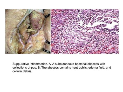 ACUTE INFLAMMATION Pptx