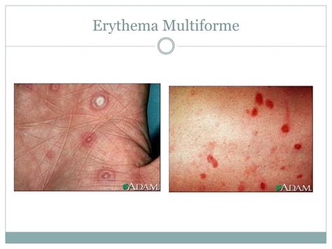 Usmle Aid On X Target Lesions Seen In Erythema Multiforme 57 Off