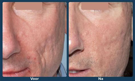 Microneedling Behandeling Met Dermapen Huidverbetering De