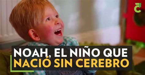 Noah el niño que nació sin cerebro