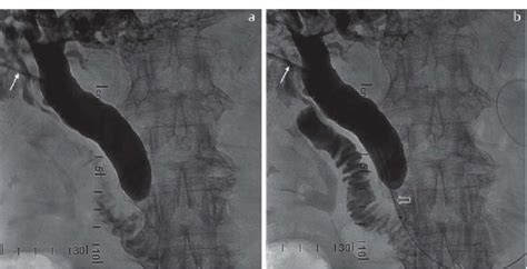 A B After Probing A Bile Duct And Inserting A Working Lock Arrow Download Scientific