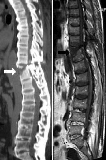 29 Hyperextension Fracture Dislocation In A Patient With Ankylosing