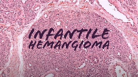 Infantile Hemangioma Strawberry Birthmark Under The Microscope