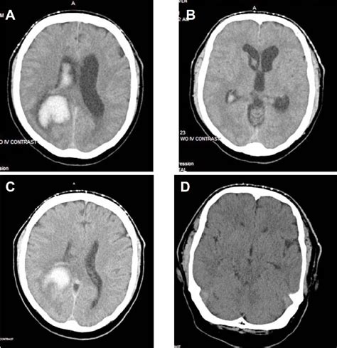 figure   lumbar catheter placement  paramedian approach
