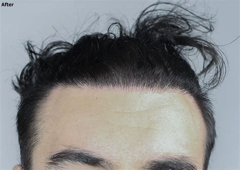 Frontal Hair Restoration Case Studies Alvi Armani Hair Transplant