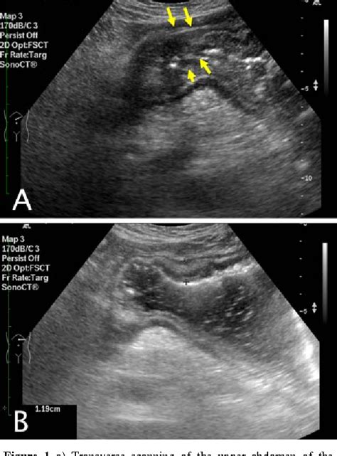 Figure 1 from Carcinoma of stomach detected by routine transabdominal ...