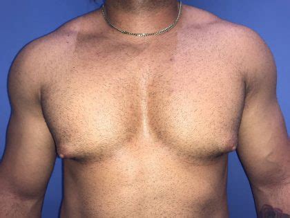 Best Gynecomastia Long Island NYC Greenberg Cosmetic Surgery