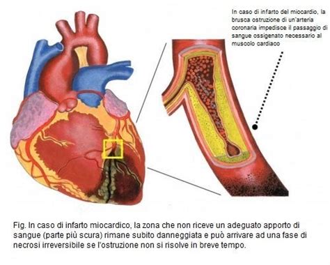 Infarto Miocardico Acuto Di Cosa Si Tratta Vivere Pi Sani