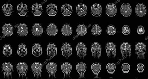 Conjunto De Exploraciones Seriadas Por Resonancia Magn Tica De Cabeza