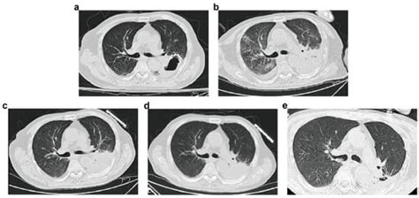 JoF Free Full Text Oral Isavuconazole Combined With Nebulized