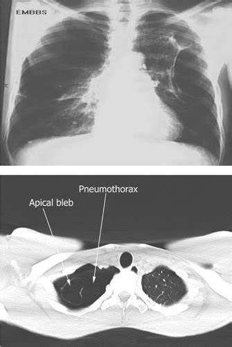 Copd Flashcards Quizlet