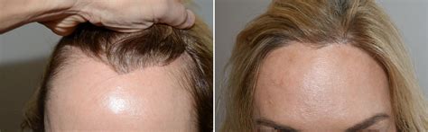 Hair Transplants For Women Special Cases Photos Miami Fl