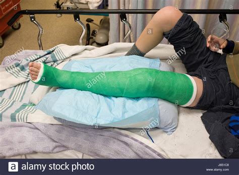 Broken Leg High Resolution Stock Photography And Images Alamy