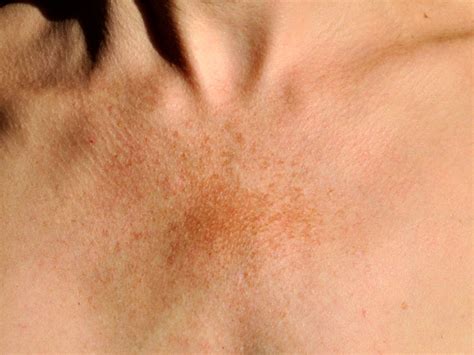 Hyperpigmentation On Face Treatment Doctor Heck