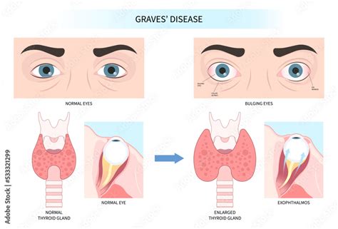 Hashimotos Thyroiditis And Graves Disease Eye Swollen Tumor Cancer