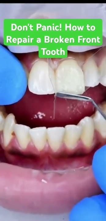 Dont Panic How To Repair A Broken Front Tooth Dentistry Youtube
