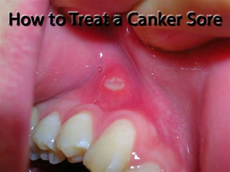 Common Causes of Canker Sores | HubPages