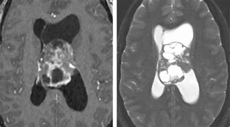 脑室内肿瘤手术策略与技巧 The Neurosurgical Atlas全文翻译 搜狐