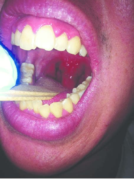 Angioedema De úvula Download Scientific Diagram