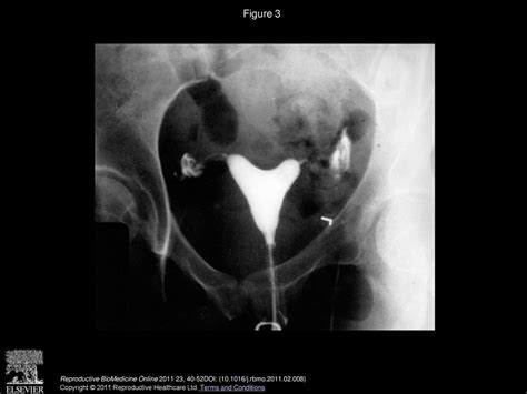 Management Of Congenital Uterine Abnormalities Ppt Download