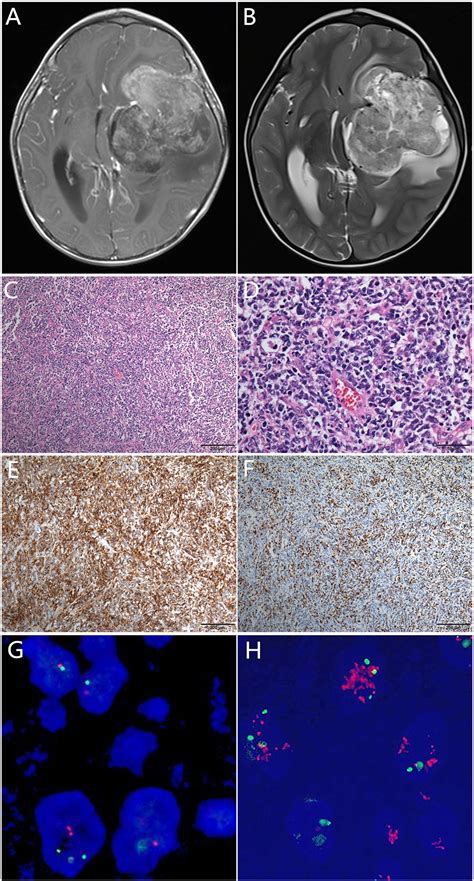 Frontiers Case Report A Unique Case Of Pediatric Central Nervous