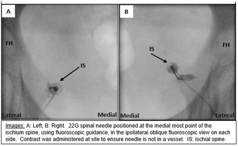 Fluoroscopy Guided Images Of Bilateral Pudendal Nerve Block