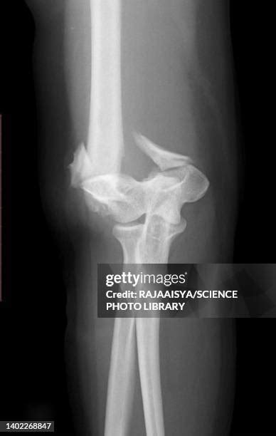 Broken Elbow X Ray Photos and Premium High Res Pictures - Getty Images