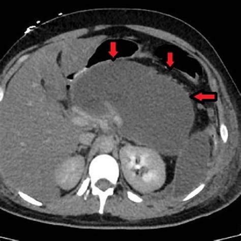 Abdominal Displaying Pancreatitis With Peripancreatic Fluid Collection