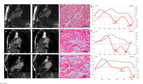 Figure 1 From Sex Differences In Atrial Remodeling And Its Relationship With Myocardial Fibrosis