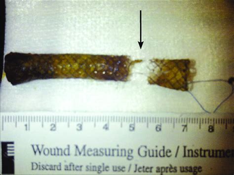 Covered self-expandable biliary metal stent after removal. The arrow ...