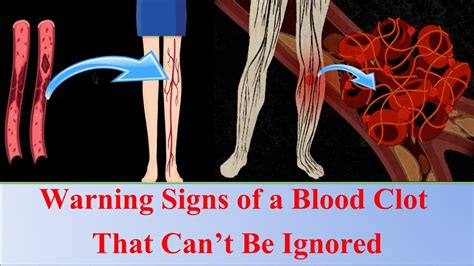 10 Signs Of Blood Clot