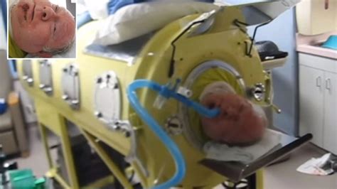 Man Who Has Lived Inside 7ft Iron Lung For 70 Years Shouldnt Be Alive The Us Sun