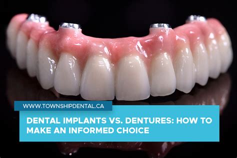 Dental Implants Vs Dentures How To Make An Informed Choice Township