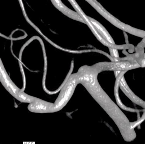 Ruptured M2 Pseudoaneurysm Pipeline Shield Embolization