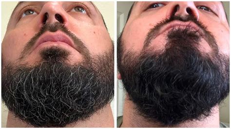 Minoxidil Beard Journey Years Later How To Grow A Real 43 Off