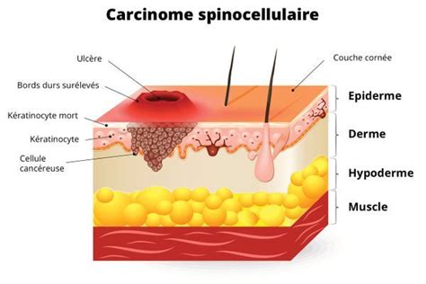 Carcinome Reconna Tre Et Soigner Les Carcinomes Basocellulaires Et