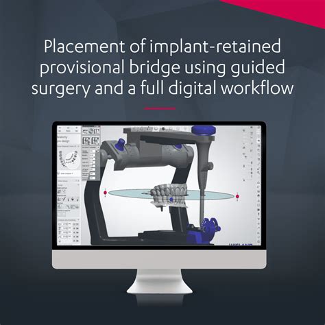 Placement of implant-retained provisional bridge using guided surgery ...