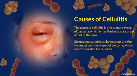 Strep Vs Staph Cellulitis