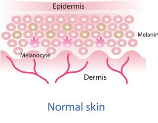 Psoriasis and normal skin layers detailed Vector Image