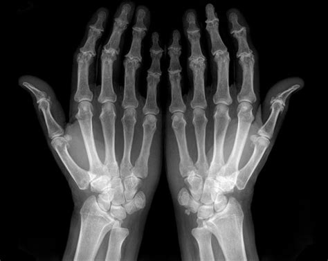 Osteoarthritis Hands X Ray