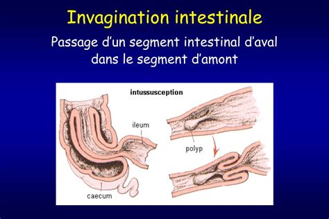 Ppt Urgences Visc Rales En P Diatrie Powerpoint Presentation Free