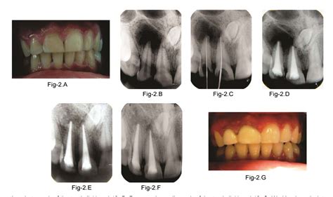 Figure From Nonsurgical Root Canal Therapy Of Large Cystic Periapical