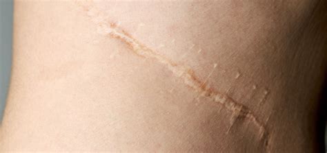 Scars Dermatology And Skin Health Dr Mendese