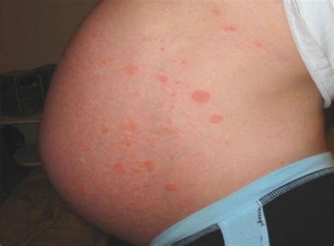 Puppp Rash In Pregnancy Natural Treatments And Prevention