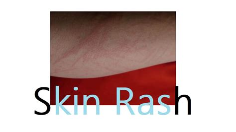 Skin Rash: 19 Types, Causes, Symptoms, And Diagnosis