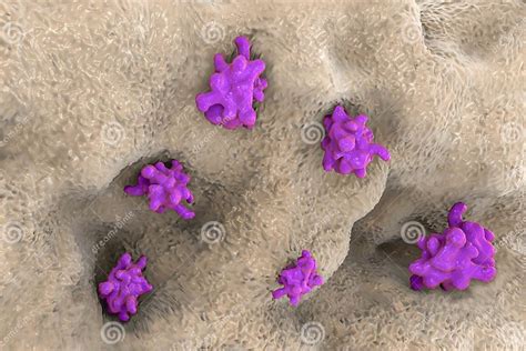 Entamoeba Histolytica Invading Intestine Stock Illustration Illustration Of Gingivalis